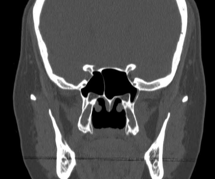 File:Acute sinusitis (Radiopaedia 22419-22455 Coronal bone window 28).jpg
