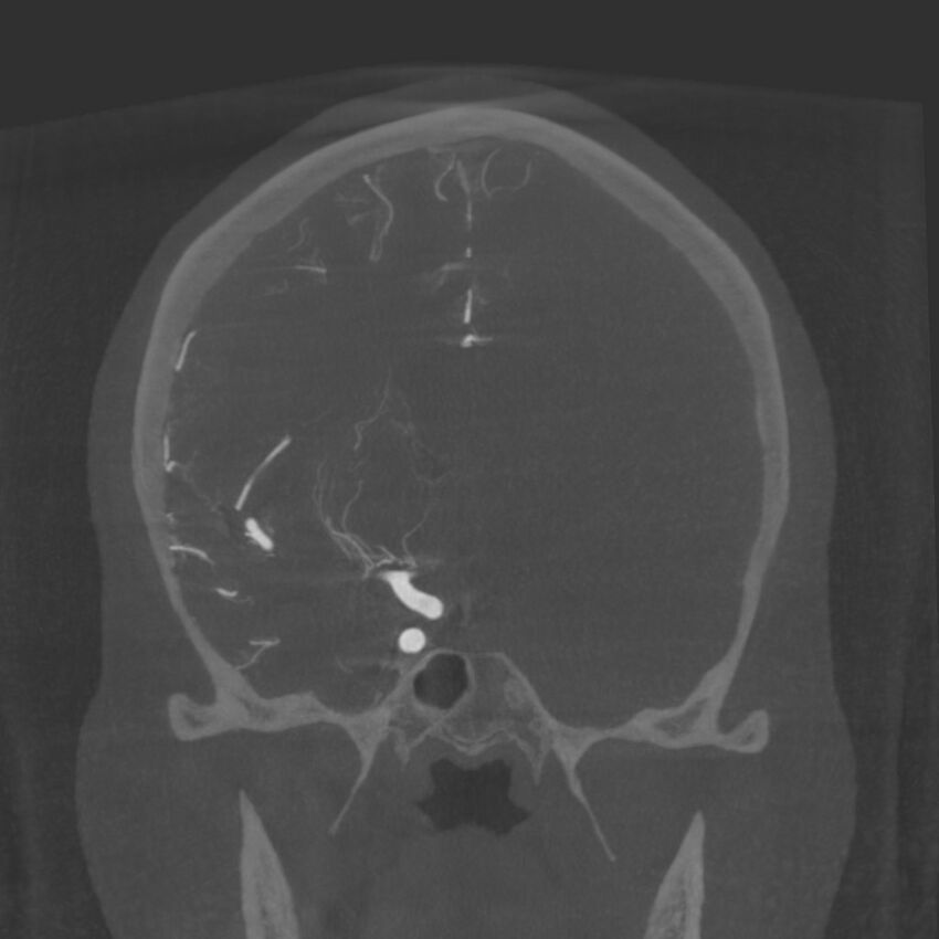 Acute subarachnoid hemorrhage and accessory anterior cerebral artery (Radiopaedia 69231-79010 Coronal arterial - MIP 45).jpg