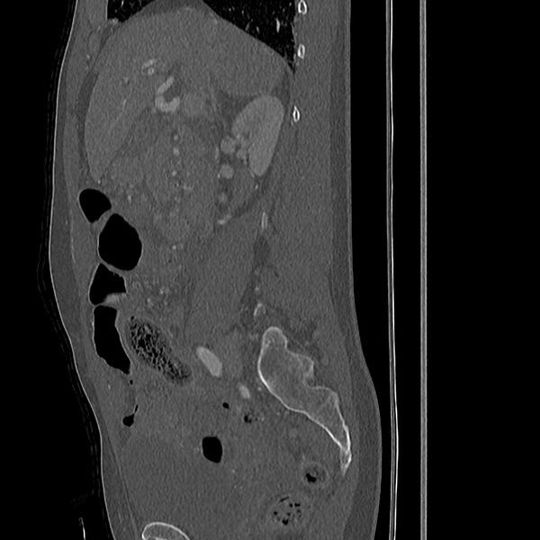 File:Acute vertebral body compression fractures (Radiopaedia 31757-32693 Sagittal bone window 45).jpg