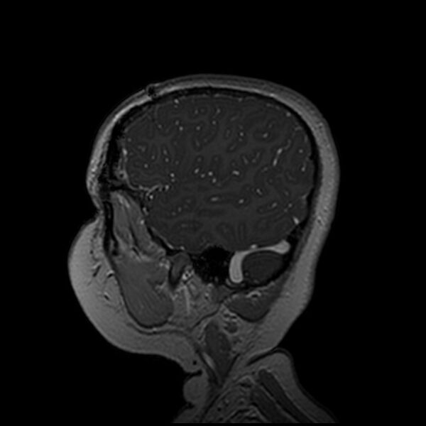 File:Adamantinomatous craniopharyngioma (Radiopaedia 77407-89529 H 100).jpg