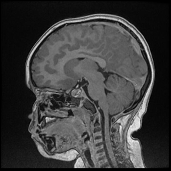 File:Adamantinomatous craniopharyngioma (Radiopaedia 77407-89529 Sagittal T1 C+ 74).jpg
