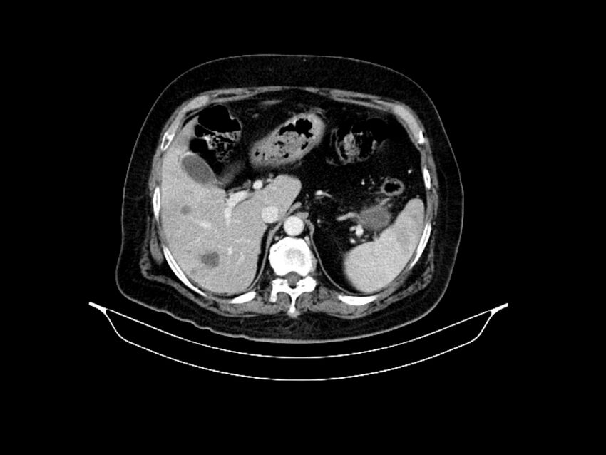 Adenocarcinoma of pancreas with hepatic metastasis (Radiopaedia 64332-73122 Axial C+ portal venous phase 28).jpg