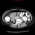 Adenocarcinoma of the colon (Radiopaedia 8191-9039 Axial liver window 39).jpg