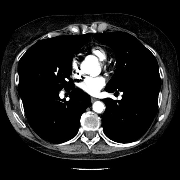 File:Adenocarcinoma of the lung (Radiopaedia 41015-43755 Axial C+ portal venous phase 68).jpg