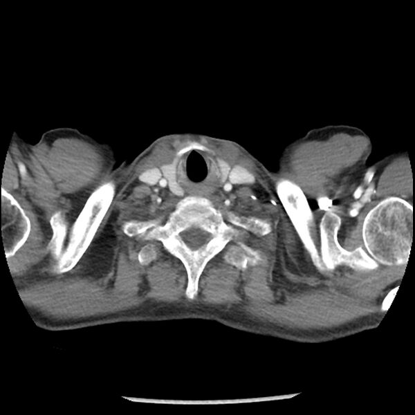File:Adenocarcinoma of the lung - micropapillary predominant (Radiopaedia 42446-45563 Axial C+ portal venous phase 1).jpg