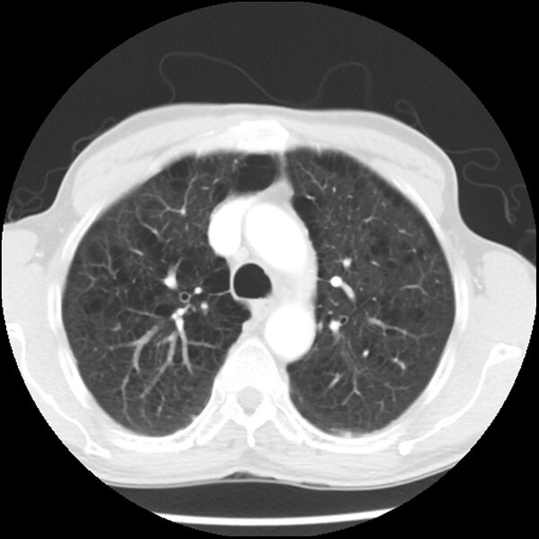File:Adenocarcinoma of the lung - micropapillary predominant (Radiopaedia 42446-45563 Axial lung window 22).jpg