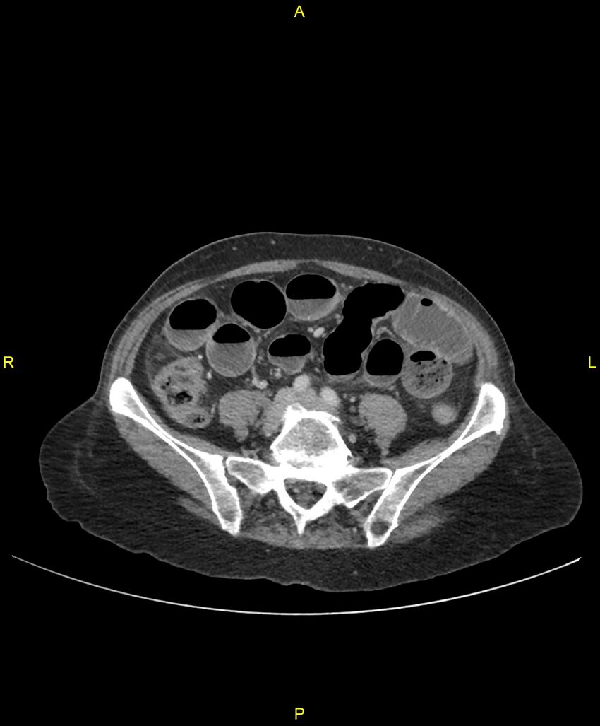 Adhesional small bowel obstruction (Radiopaedia 85402-101024 Axial C+ portal venous phase 189).jpg