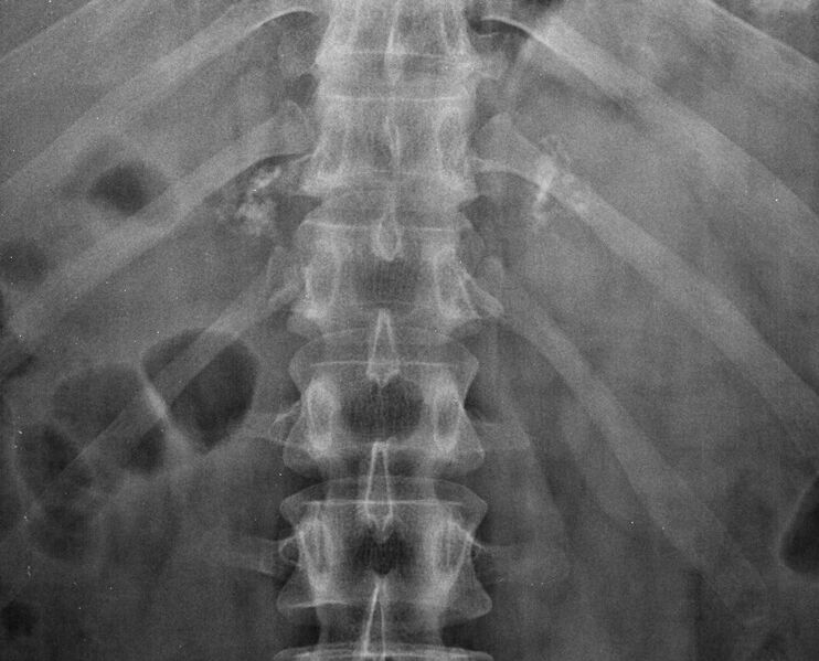 File:Adrenal calcification (Radiopaedia 19624-19663 Frontal (zoomed in) 1).jpg