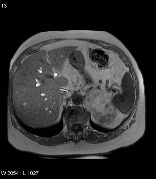 File:Adrenal myelolipoma (Radiopaedia 6765-7961 Axial T1 in-phase 13).jpg