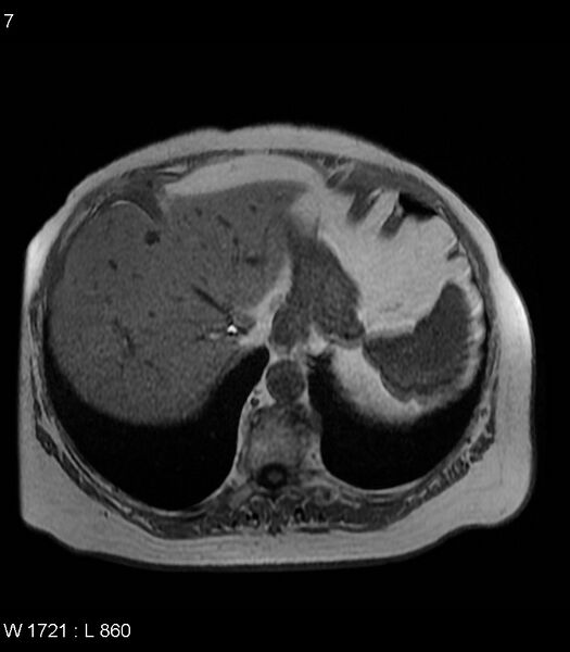 File:Adrenal myelolipoma (Radiopaedia 6765-7961 Axial T1 in-phase 7).jpg