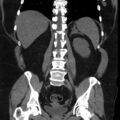 Adrenal myelolipoma (Radiopaedia 8216-9068 non-contrast 13).jpg