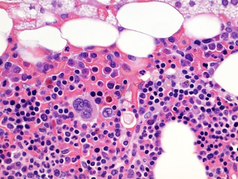 File:Adrenal myelolipoma (pathology) (Radiopaedia 19001-18961 400x H&E 1).jpg
