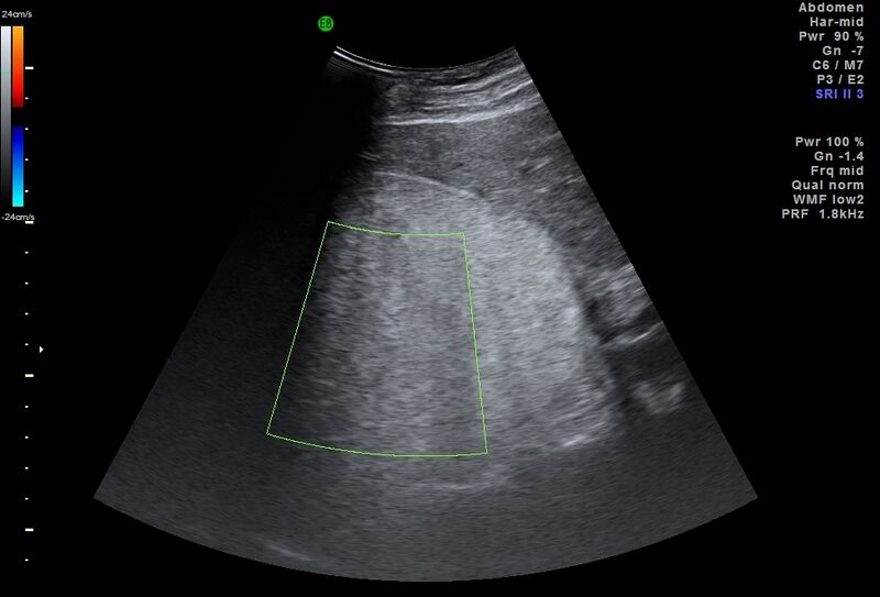 File:Adrenal myelolipoma - bilateral (Radiopaedia 74805-85811 Abdominal ultrasound 5).jpg