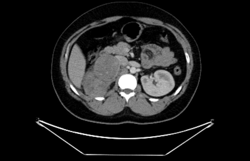 File:Adrenocortical carcinoma (Radiopaedia 80134-93438 Axial C+ portal venous phase 51).jpg