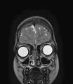 Aicardi syndrome (Radiopaedia 66029-75205 Coronal T2 2).jpg