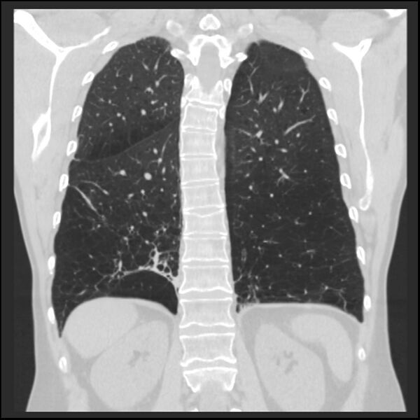 File:Alpha-1-antitrypsin deficiency (Radiopaedia 40993-43722 Coronal lung window 78).jpg
