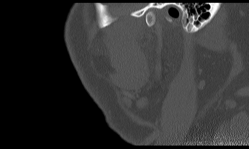 Ameloblastoma (Radiopaedia 33677-34806 Sagittal bone window 53).png