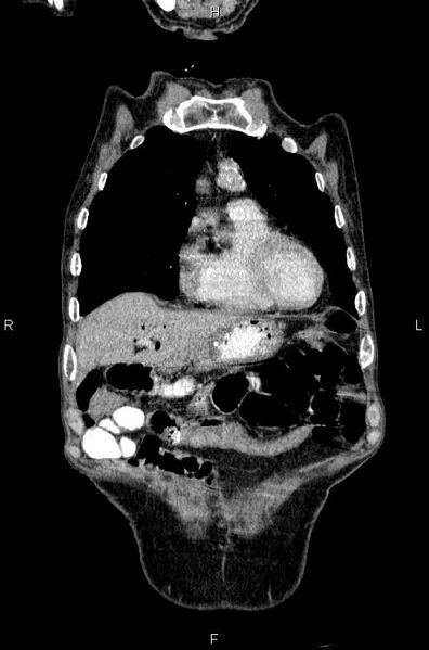 File:Ampullary adenocarcinoma (Radiopaedia 86093-102033 D 12).jpg