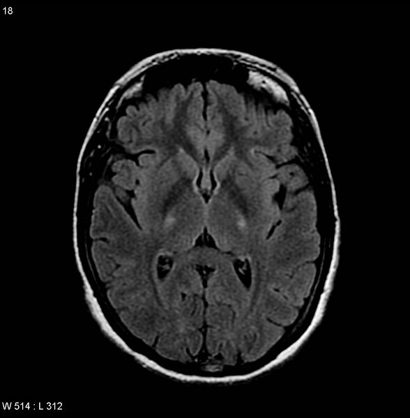 File:Amyotrophic lateral sclerosis (Radiopaedia 4719-6744 Axial FLAIR 4).jpg