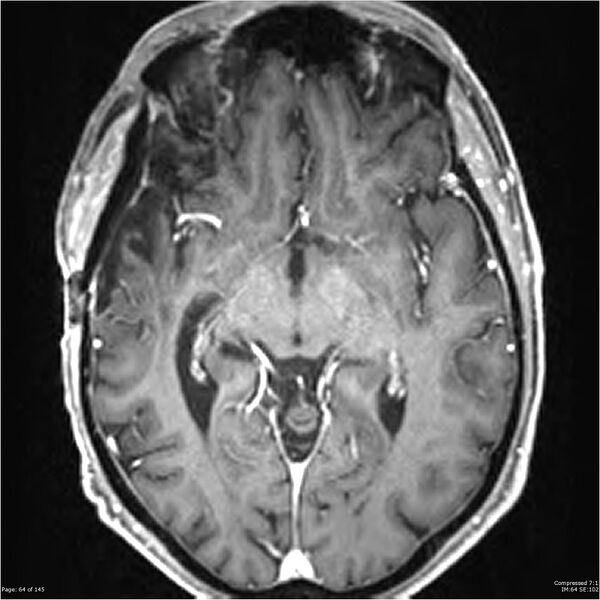 File:Anaplastic meningioma with recurrence (Radiopaedia 34452-35788 Axial T1 C+ 64).jpg