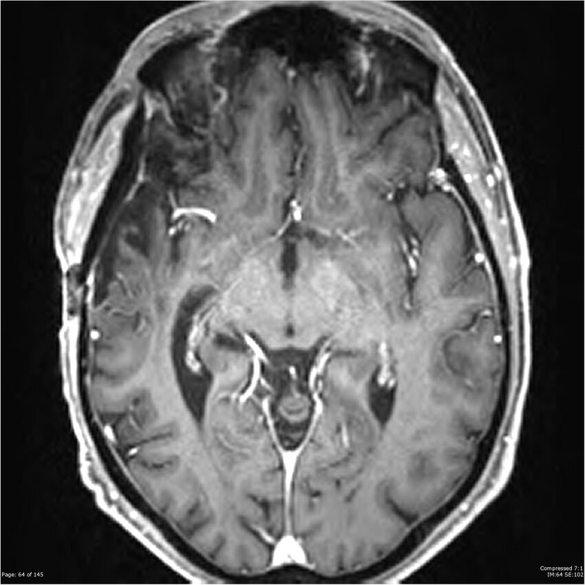 Anaplastic meningioma with recurrence (Radiopaedia 34452-35788 Axial T1 C+ 64).jpg