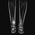 Aneurysmal bone cyst - tibia (Radiopaedia 22343-22367 Coronal T2 10).jpg