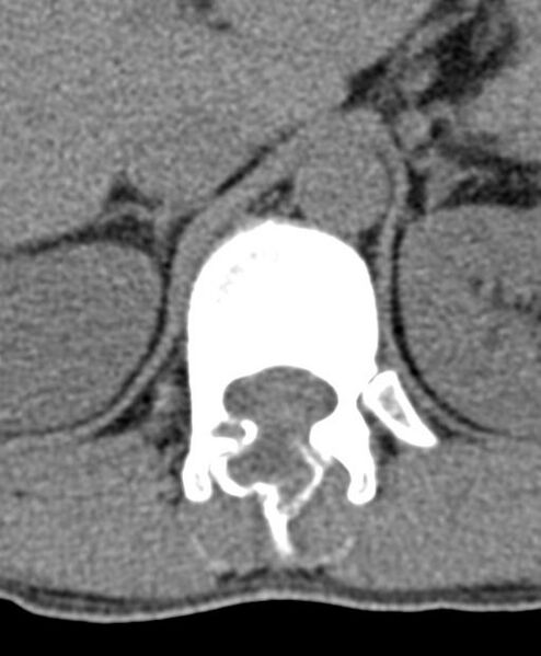 File:Aneurysmal bone cyst T11 (Radiopaedia 29294-29721 Axial non-contrast 50).jpg