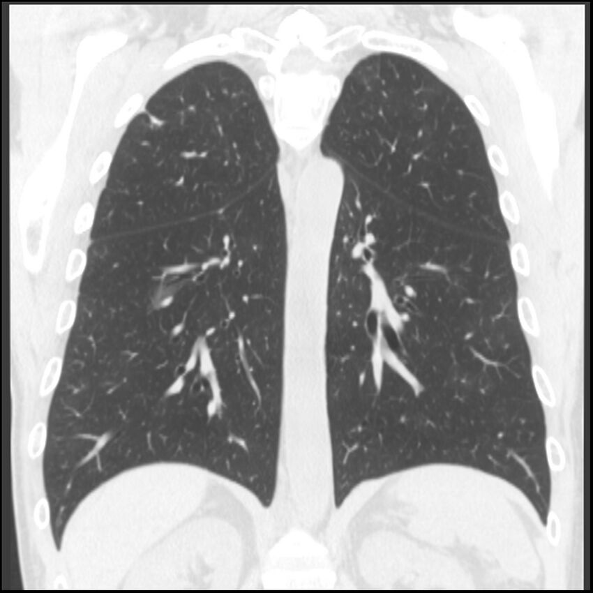 Angioinvasive aspergillosis (Radiopaedia 43957-47466 Coronal lung window 33).jpg