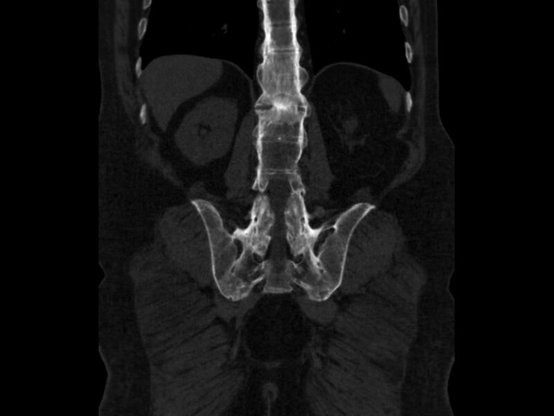 File:Ankylosing spondylitis (Radiopaedia 44609-48357 Coronal bone window 71).jpg