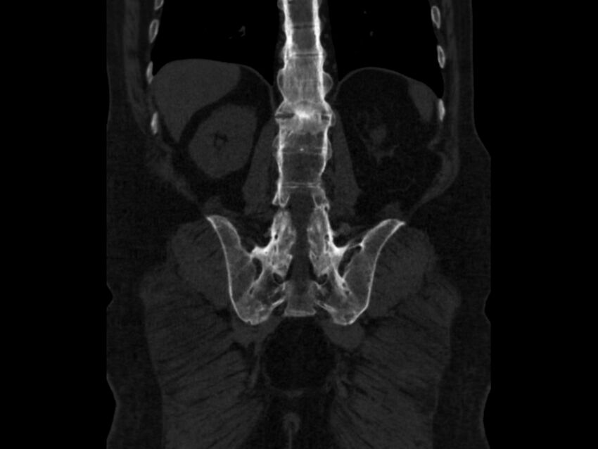 Ankylosing spondylitis (Radiopaedia 44609-48357 Coronal bone window 71).jpg