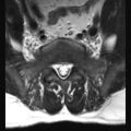 Ankylosing spondylitis with zygapophyseal arthritis (Radiopaedia 38433-40516 Axial T2 1).jpg