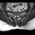 Ankylosing spondylitis with zygapophyseal arthritis (Radiopaedia 38433-40517 B 4).jpg