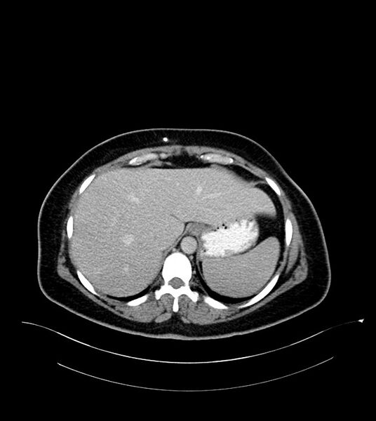 File:Anterior abdominal wall CSF pseudocyst (CSFoma) (Radiopaedia 79453-92571 A 20).jpg