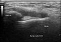 Anterior talofibular ligament injury (Radiopaedia 40411).jpg