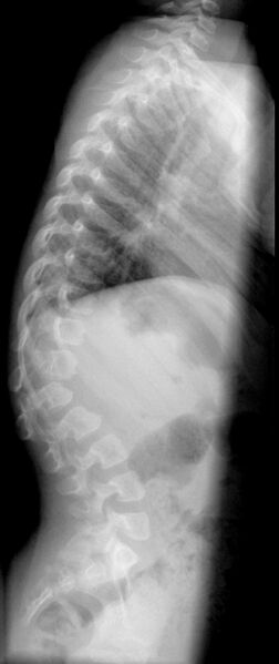 File:Anterior vertebral beaking secondary to trauma (Radiopaedia 24323-24602 Lateral 1).jpg