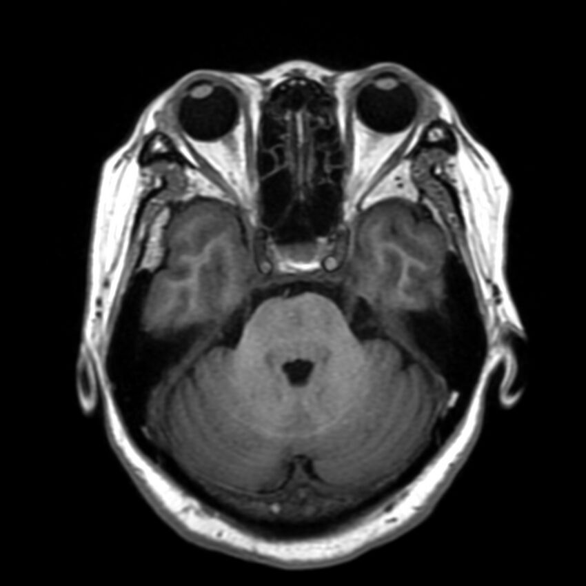 Anti-MOG encephalomyelitis (Radiopaedia 73831-84646 Axial T1 16).jpg