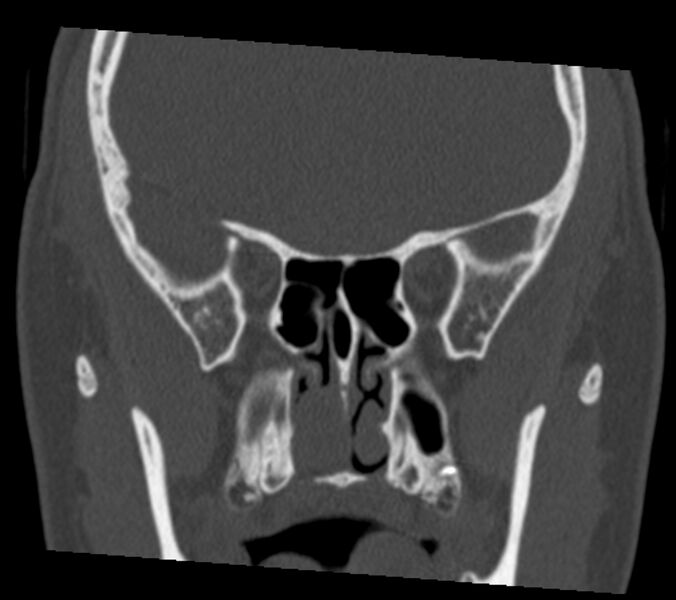 File:Antrochoanal polyp (Radiopaedia 21894-21868 Coronal bone window 22).jpg