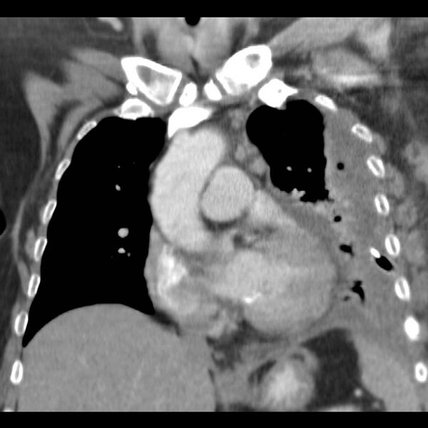 File:Aortic arch false aneurysm (Radiopaedia 14667-14588 B 2).jpg