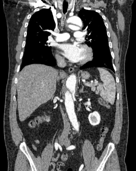File:Aortic dissection (Radiopaedia 44411-48061 A 26).jpg