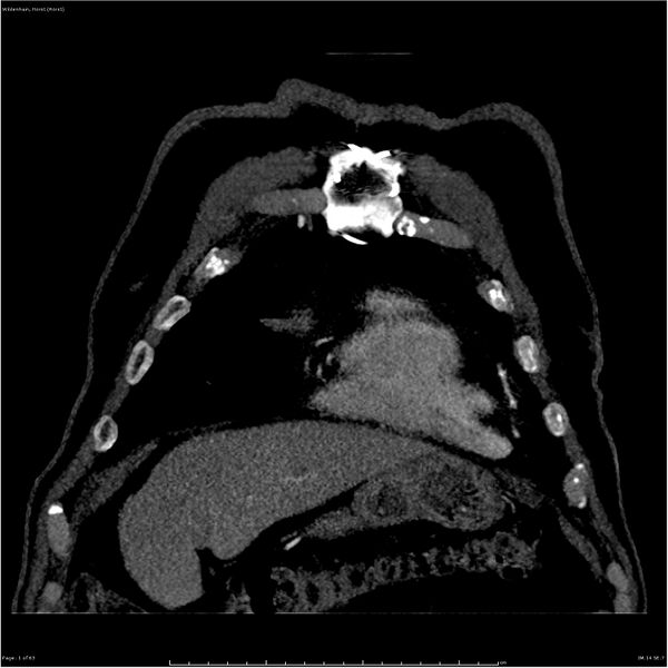 File:Aortic dissection - Stanford type A (Radiopaedia 26183-26315 A 1).jpg
