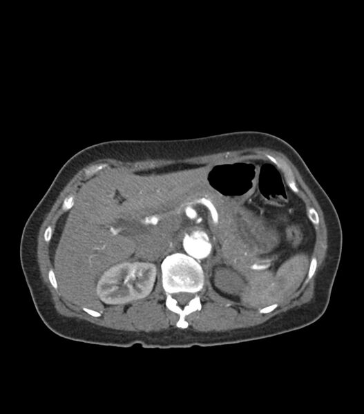 File:Aortic dissection with renal ischemia (Radiopaedia 76573-88338 A 62).jpg