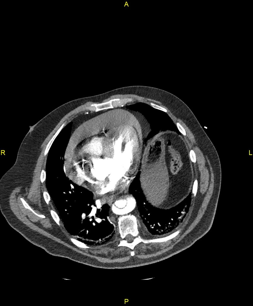 Aortic rupture (Radiopaedia 88822-105594 B 161).jpg