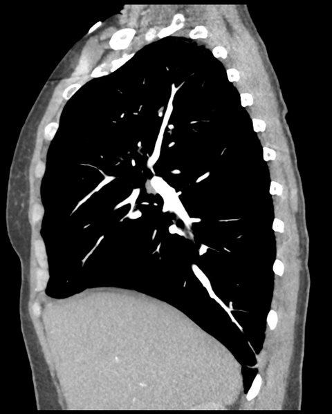 File:Aortic valve non-coronary cusp thrombus (Radiopaedia 55661-62189 D 36).png