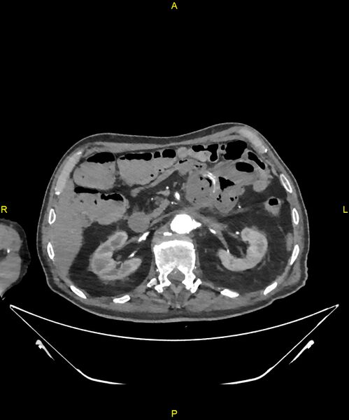 File:Aortoenteric fistula (Radiopaedia 84308-99603 B 109).jpg