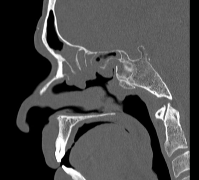 File:Aplastic maxillary sinuses (Radiopaedia 60030-67561 Sagittal bone window 13).jpg