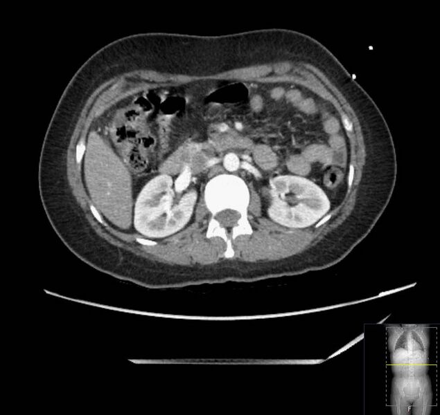 File:Appendicitis (CT angiogram) (Radiopaedia 154713-127660 Axial 117).jpg