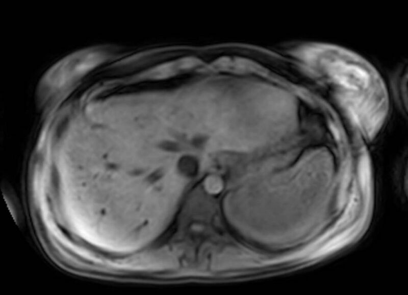 File:Appendicitis in gravida (MRI) (Radiopaedia 89433-106395 Axial DIXON 8).jpg