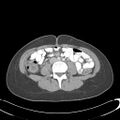 Appendicitis with minimal stranding but appendicolith (Radiopaedia 29035-29397 A 49).jpg