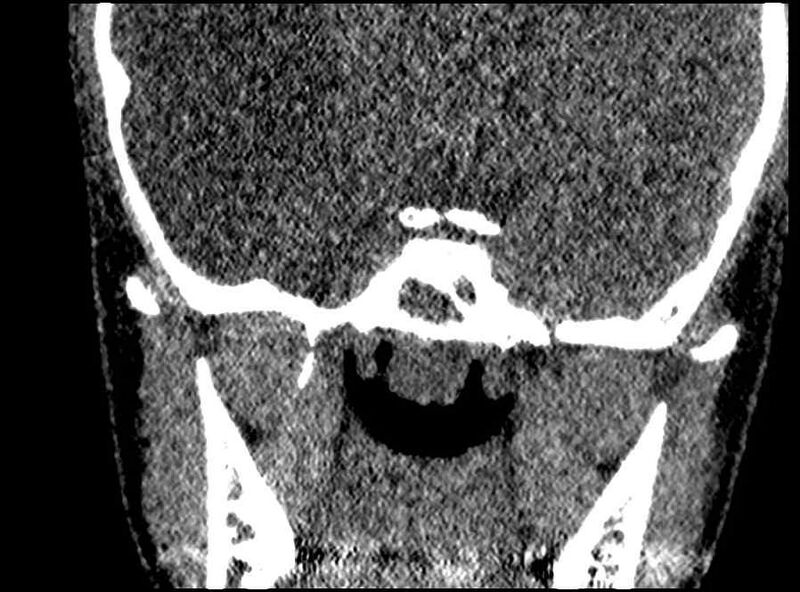 File:Arachnoid cyst- extremely large (Radiopaedia 68741-78450 Coronal bone window 11).jpg
