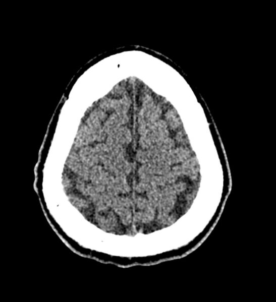 File:Arachnoid cyst of the ambient cistern (Radiopaedia 81301-94986 Axial non-contrast 60).jpg